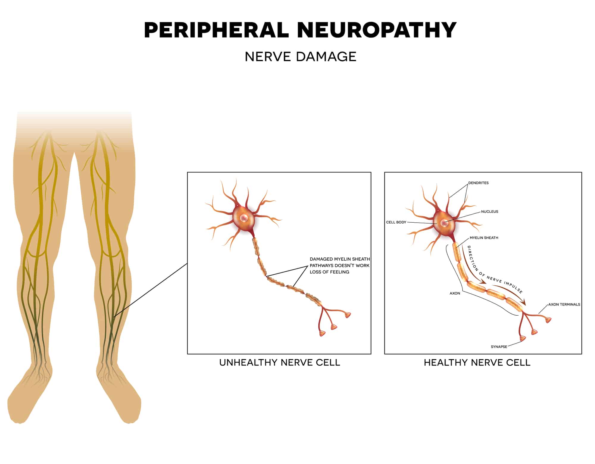 Periferna neuropatija